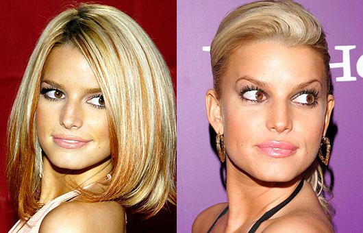 Jessica Simpson injekcijas... Autors: UglyPrince Plastiskā ķirurģija