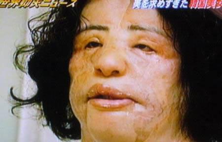 Šī 48gadus vecā sieviete no... Autors: UglyPrince Plastiskās ķirurģijas upuri
