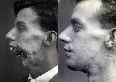 Pirms un pēc sejas... Autors: desantnieks Pirmā plastiskā operācija