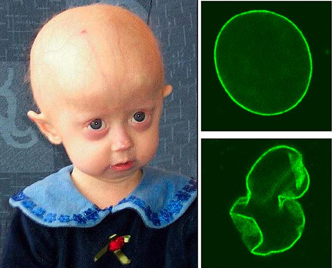 Sindroma nosaukums ... Autors: Fosilija Progeria - Mirsti Jauns!