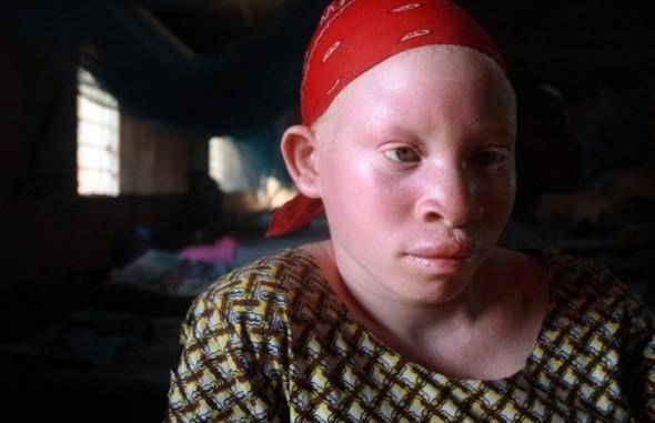 Šī meitene dzīvo Kabange... Autors: marju6ka Āfrikas albīni