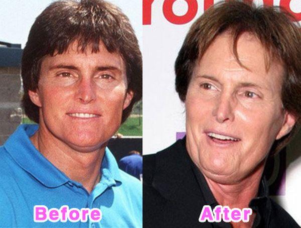 Bruce Jenner Autors: bee62 16 Worst Celebrity Plastic Surgery Disasters part 1