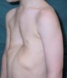 Piltuvveida  kurpnieka krūtis Autors: Fosilija Krūšu kaula deformācija