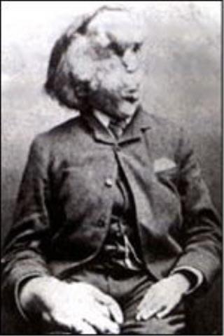 Džozefs Meriks piedzima 1862... Autors: devileens Ziloņcilvēks