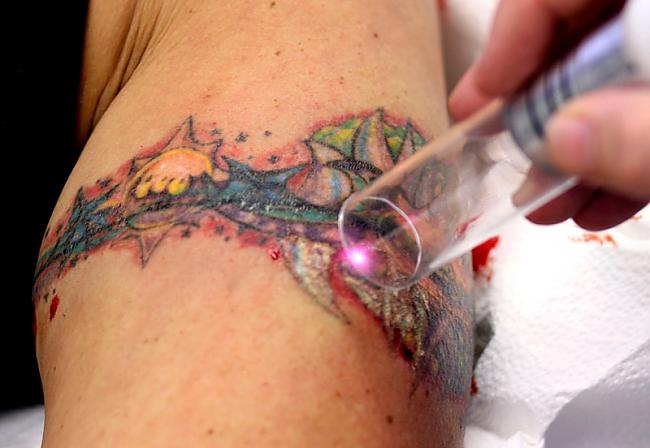  Autors: Kobis Tetovējumu dzēšana...
