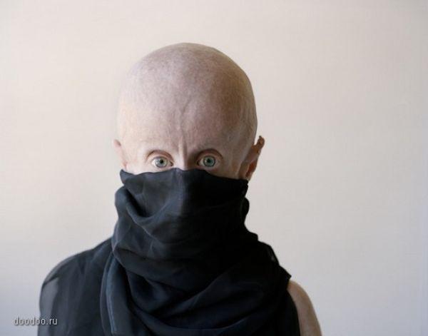 Skumji Progeria sindroms ir... Autors: agonywhispers cilvēks citplanētietis - Leon Botha