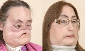 Ķirurgi no Klīvlendas klīnikas... Autors: FoxxH Ārsti sievietei izveido jaunu seju.