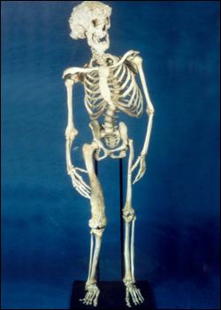Josepha Merricka skelets Autors: exkluzīvais Proteus Syndrome