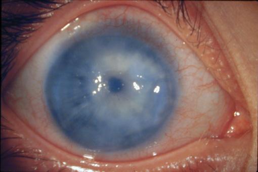 Glaukomas iemesli nav precīzi... Autors: bubina696 Dažas izplatītākās acu slimības