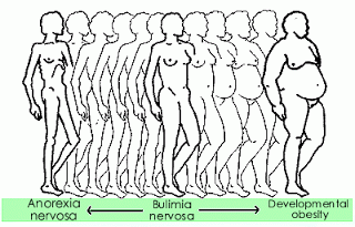  Autors: proviking Anorexia Nervosa, nav slimība, bet dzīves veids