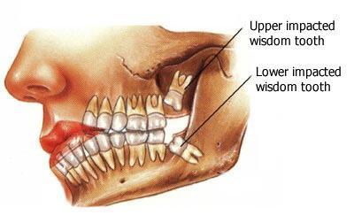 Gudrības zobiGudrības zobi... Autors: Fosilija Cilvēkam nevajadzīgie orgāni un ķermeņa daļas.