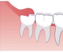 Gudrības zobi Pirmatnējiem... Autors: twist 7 nevajadzīgi ķermeņa orgāni