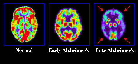 Alcheimera slimība ir... Autors: sendijazzz 3 Slimības par kurām tu tagad izglītosies.