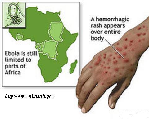 Ebolas simptomi parasti sākas... Autors: Vampire Lord Par Ebolas vīrusu un tā īpašībām.