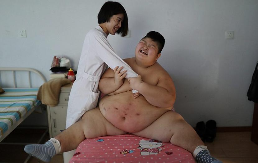 Pēc China Dailu sniegtās... Autors: matilde 150kg smagais bērns cenšas zaudēt svaru ar uguns palīdzību