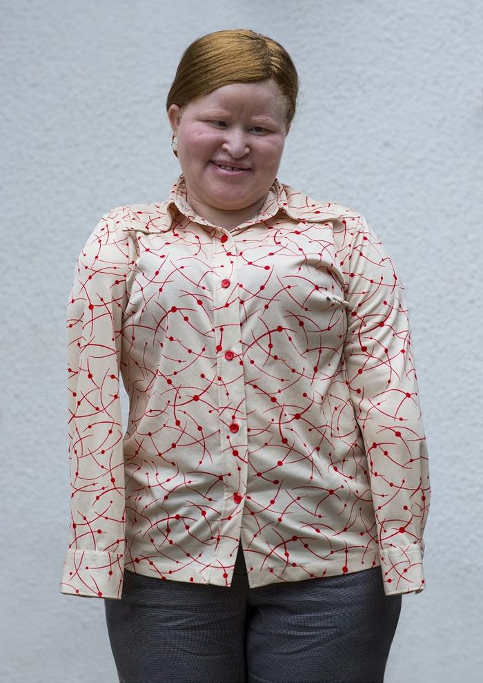32 gadīgā Mariam arī ir albīns... Autors: slida Cilvēks, kura ķermenis vērtīgāks par zeltu. Traģisks stāsts.