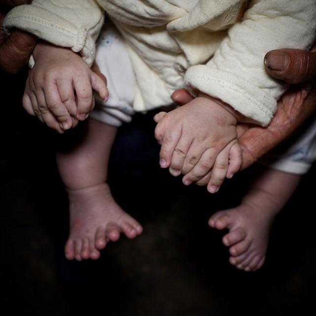Scaronim mazulim ir 15 pirksti... Autors: matilde Cilvēki dalās ar fotogrāfijām, kurās redzamas viņu dīvainākās ķermeņa daļas