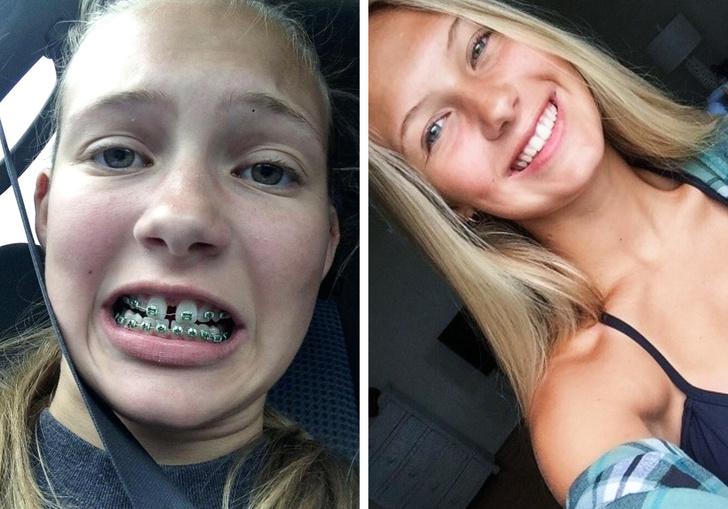  Autors: matilde 23 cilvēki padalījās ar savām «pirms» un «pēc» zobu brekešu bildēm