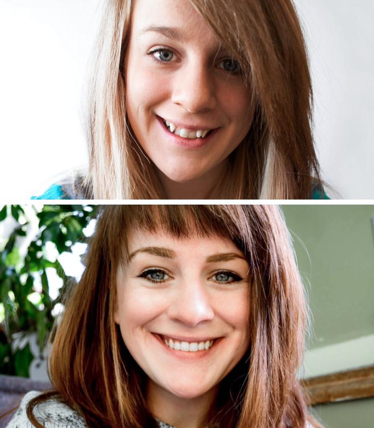  Autors: matilde 23 cilvēki padalījās ar savām «pirms» un «pēc» zobu brekešu bildēm